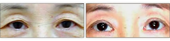 Blepharoplasty Patient Before & After Photo