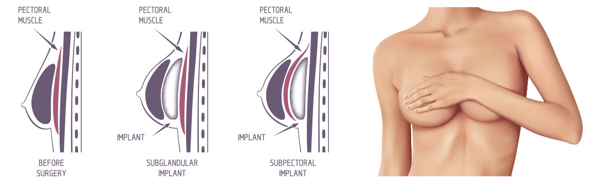 Illustrates the placement of the breast implants for breast augmentation surgery. The image above illustrates the 2 common placements of the breast implant for breast augmentation surgery. Subglandular or subpectoral. Note how the implant appears either above or below the pectoral muscle.
