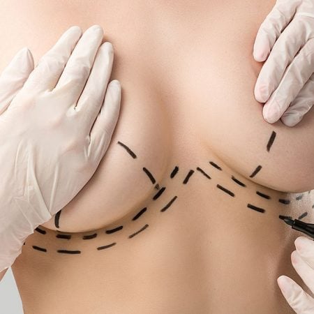 A person at a breast lift consultation has surgical guidelines marked on their skin by a gloved professional.