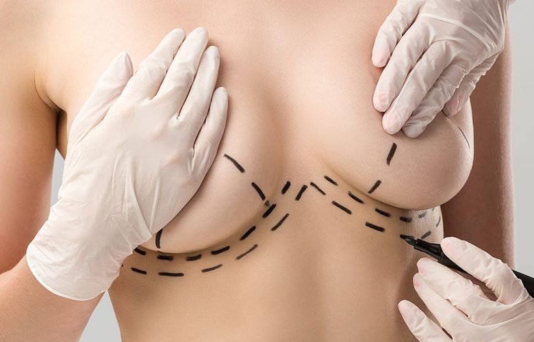 A person at a breast lift consultation has surgical guidelines marked on their skin by a gloved professional.