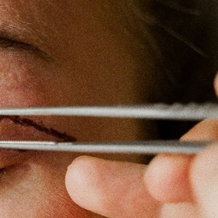 Closed eye with surgical markings; tweezers near eyelid for cosmetic surgery. Smooth skin