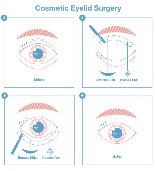 Basic Blepharoplasty Surgical Procedure Diagram The illustration is a very simplified depiction of the more common, stripped down, basic components of blepharoplasty surgery. The diagram shows the removal of excess skin and surplus fat from the upper and lower lids. It should be noted that very few real-world cases actually match the diagram. Every blepharoplasty surgery is different as a result of the fact that every patient is different in their needs and their anatomy.