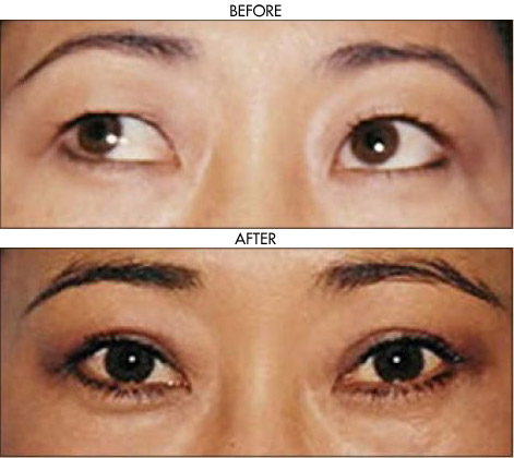 Facelift before and after