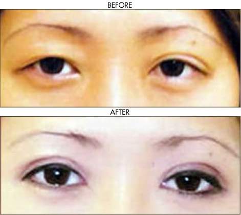 Facelift before and after