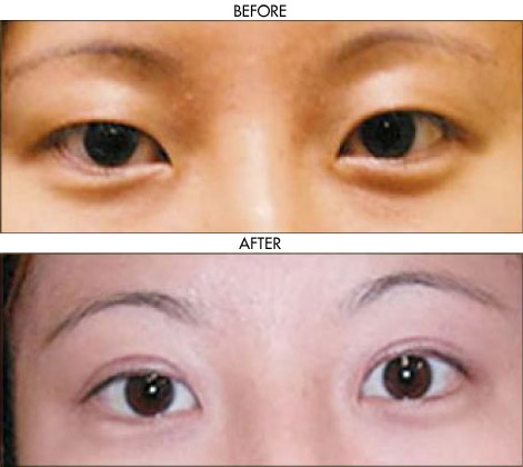 Facelift before and after