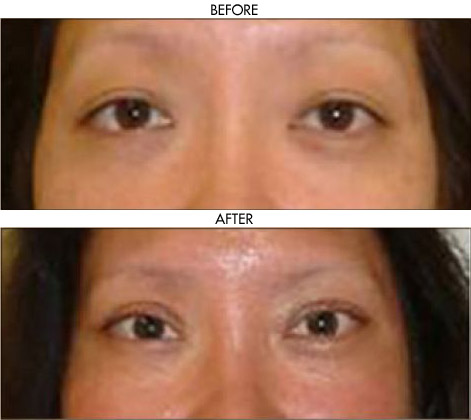 Facelift before and after