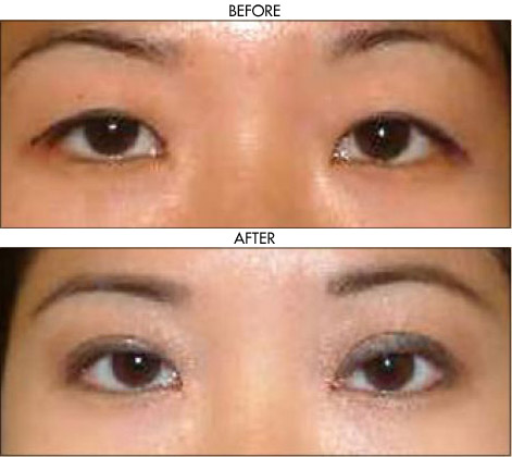 Facelift before and after