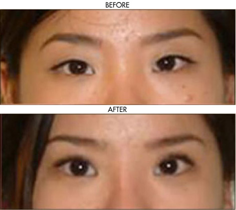 Facelift before and after