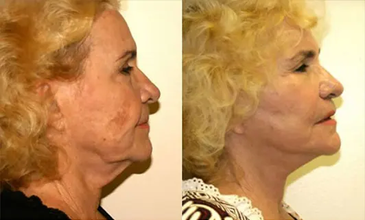 Facelift before and after