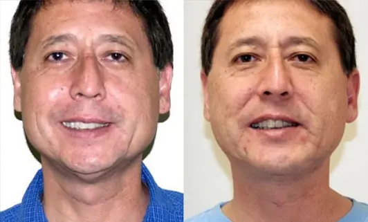 Facelift before and after