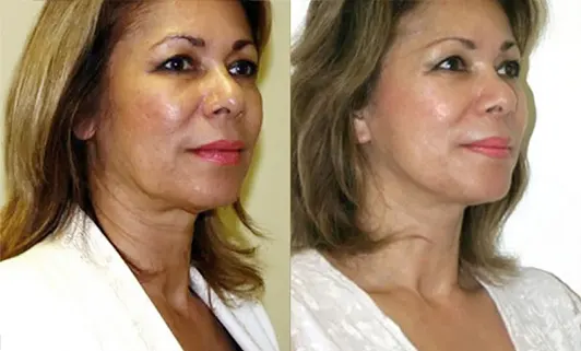 Facelift before and after