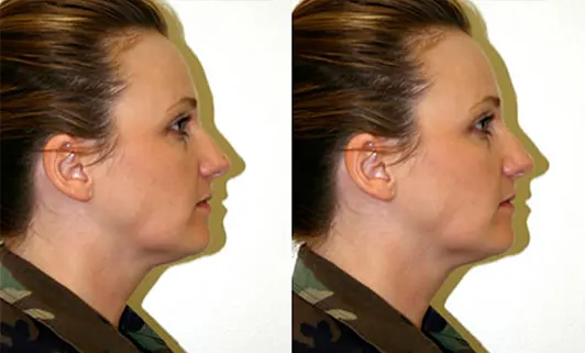 Facelift before and after