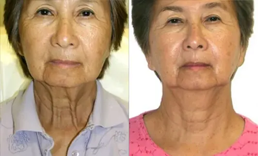 Facelift before and after