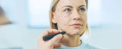 A calm blonde woman sits as surgical lines are drawn on her face