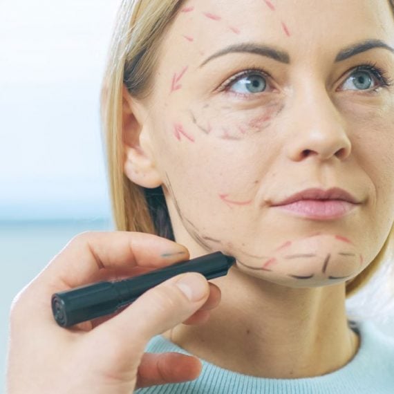 A calm blonde woman sits as surgical lines are drawn on her face