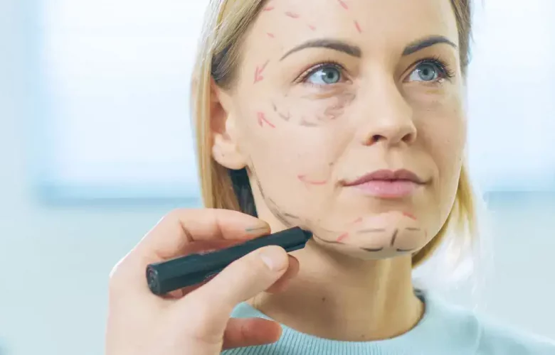 A calm blonde woman sits as surgical lines are drawn on her face