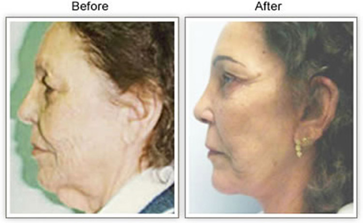 Facelift before and after