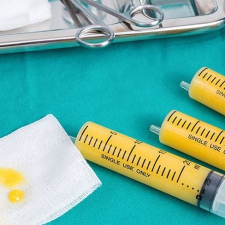 Fat transfer setup: syringes with fat