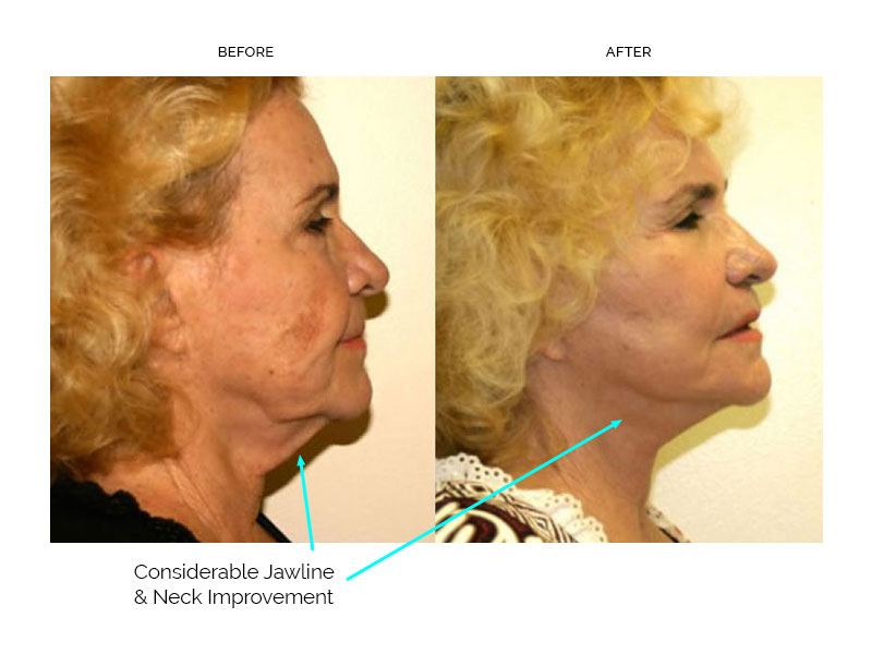 Before and after facelift results showing improved jawline definition and tighter neck contour in an older woman