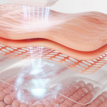 Laser skin treatment targets skin layers to improve texture and appearance.