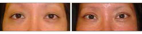 Lateral Canthoplasty Before & After Photo