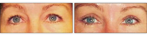 Lateral Canthoplasty Before & After Photo