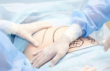 Surgeons perform liposuction on a marked abdomen in a sterile operating room with blue drapes.