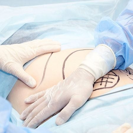 Surgeons perform liposuction on a marked abdomen in a sterile operating room with blue drapes.