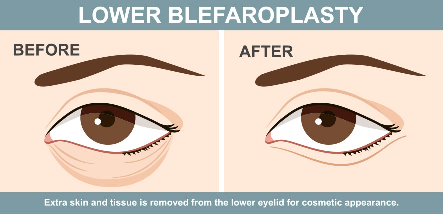 Lower Blepharoplasty