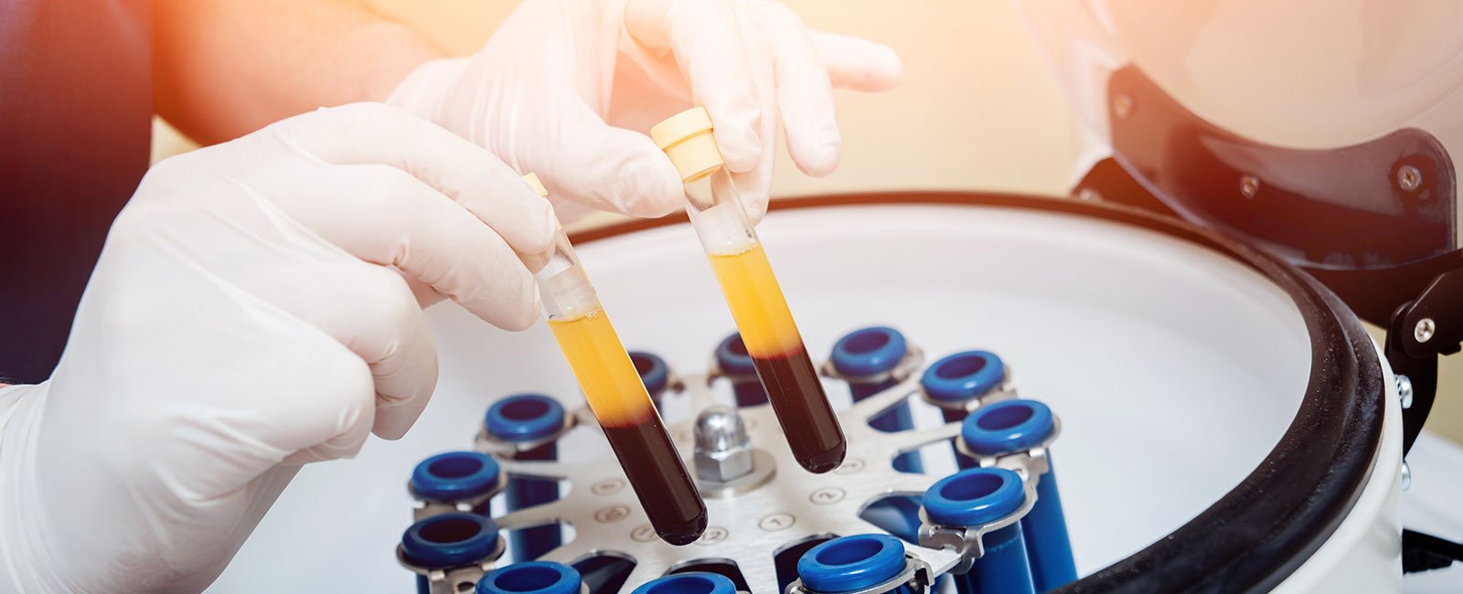 plastic-surgery-hawaii-hero-1 Gloved hands hold two yellow plasma test tubes above a centrifuge with multiple test tubes.