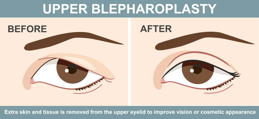 Upper Blepharoplasty The illustration depicts one of the operative goals of upper blepharoplasty surgery. The image shows postoperative outcome from the removal of excess skin from the upper lid which had resulted in a condition called hooding where the excess skin begins to drop over from the top of the upper lid.