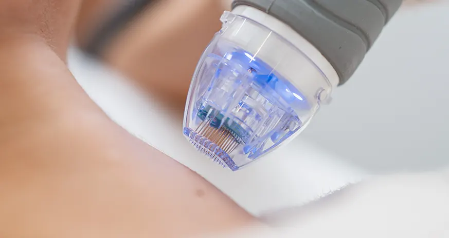 what-is-microneedling-3